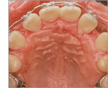 上顎前突　～出っ歯の治療例～