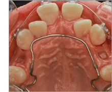 上顎前突　～出っ歯の治療例～